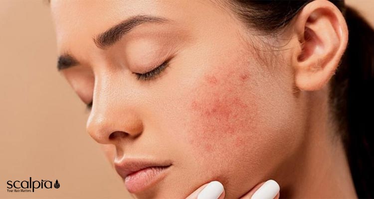 راهنمای انتخاب سیندت ژل شستشوی مناسب برای پوست آکنه‌دار